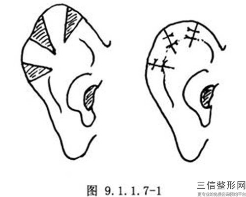 深汕中心医院整形烧伤科整形价格(价目)现已公示-全耳廓再造术案例