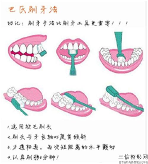 2024年潮州市牙齿修复双搭桥价格(费用)清单公布一览