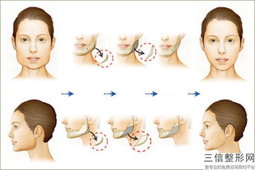 西安医学院第二附属医院--医学整形部切下巴手术做怎么样效果好吗-附整形价目表