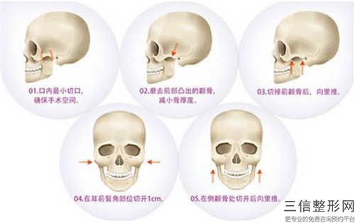 西安诺颜医疗美容颧骨整型技术手术价格多少钱啊